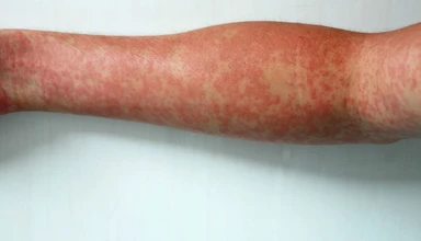 Arm with Measles rash